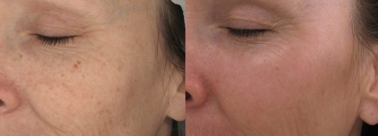 Лицо после лазерного омоложения