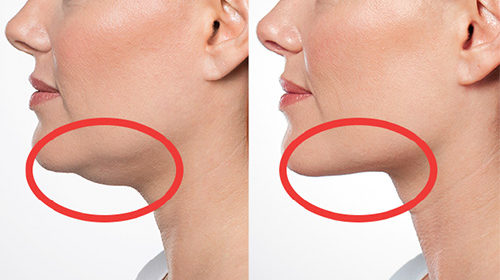 второй подбородок